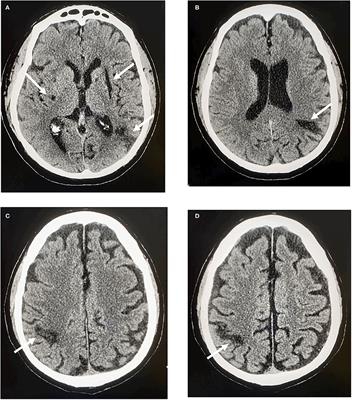 Atrial Fibrillation and Resistant Stroke: Does Left Atrial Appendage Morphology Matter? A Case Report